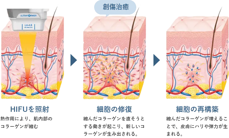 HIFUの仕組み