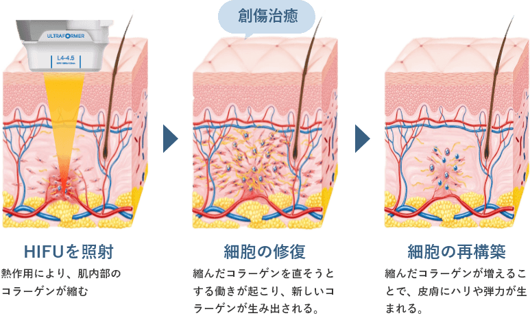 HIFUの仕組み